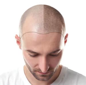 Ein Mann, der seinen Haarausfall behandelt hat und wo man beides sieht: Haarausfall und Haarnachwuchs