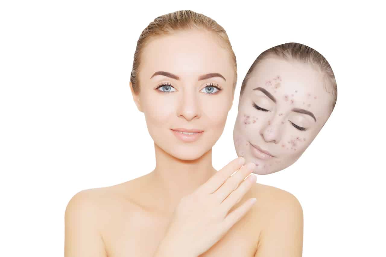 Eine Frau mit einer Maske mit Akne als Symbol für den Zusammenhang von Hautkrankheiten und Psyche