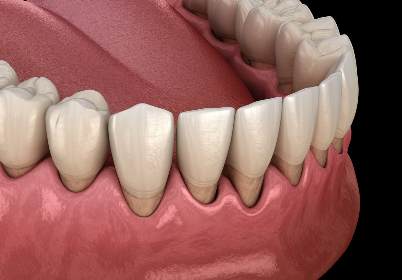 Illustration von Zahnfleischschwund und Parodontitis