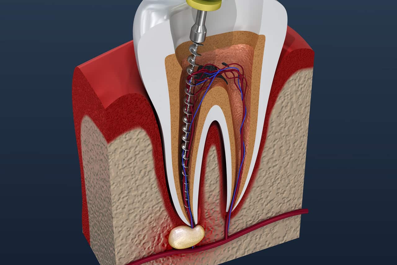 Grafik einer Wurzelbehandlung - Ein Bohrer in der Zahnwurzel